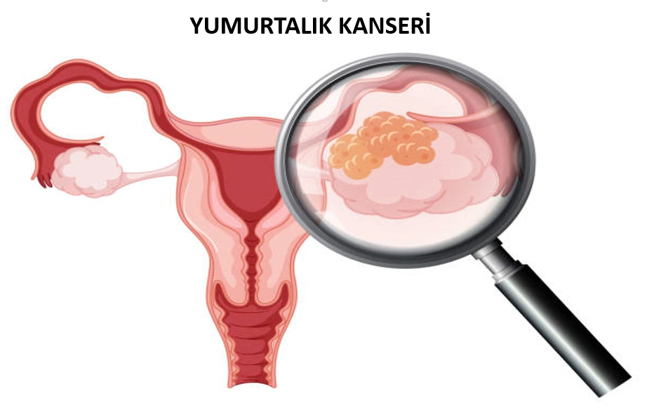 Ovarian Cancer